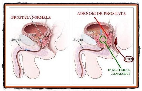 adenom de prostată și prostatita