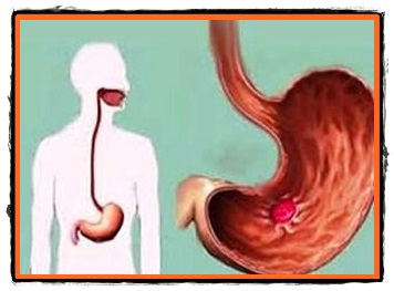 Ulcerul gastro duodenal tratamente si remedii naturiste