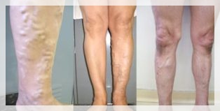 ihs i varicose vene tratamentul cu uleiuri eseniale varicoza pe picioare